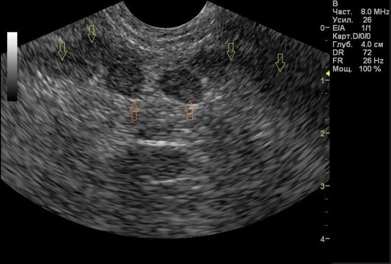 Prostatitis auf Ultraschallergebnissen